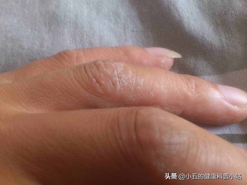 鱼油到底有什么作用？全面介绍鱼油的营养价值及适用疾病