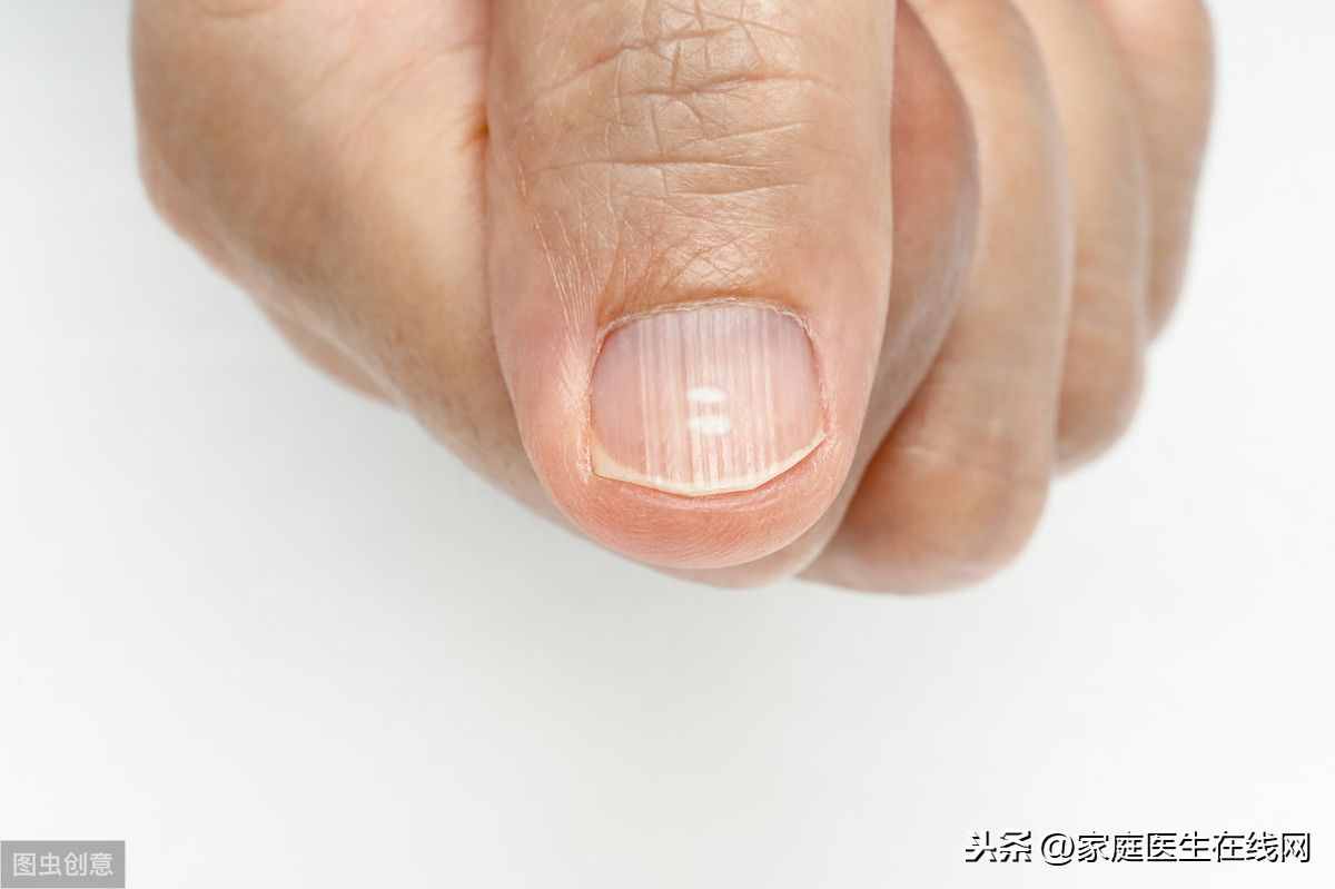 指甲有竖纹是怎么回事？总结6个原因，都要重视