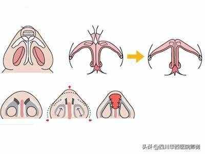 鼻翼缩小术三种常见方法