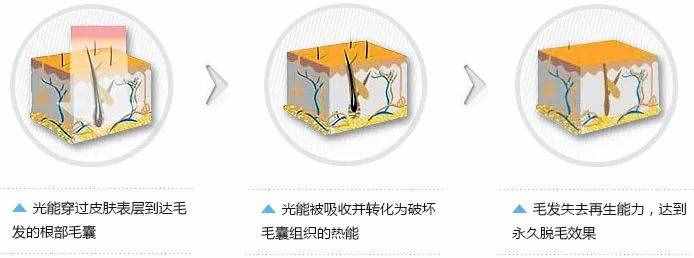 10分钟永久全身脱毛，给你一个滑溜溜的夏天