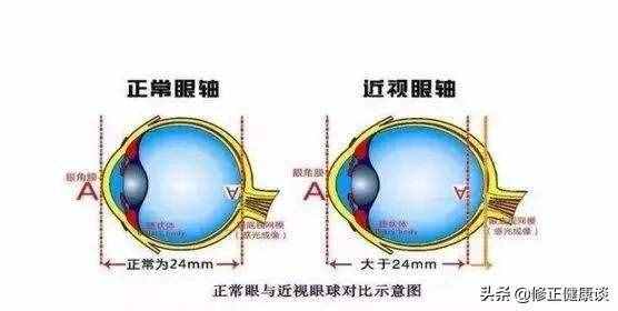 近视的人，经常戴眼镜让眼睛变形了，怎么办