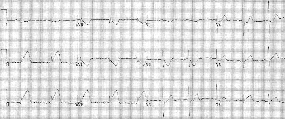 不可错过的心肌梗死图形｜识“图”寻踪