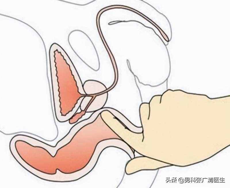 前列腺的“爆菊花”指检法