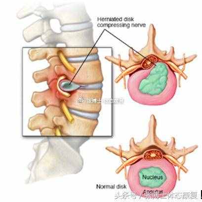 「运动康复科普」关于腰椎间盘突出的科普-症状、类型与康复训练