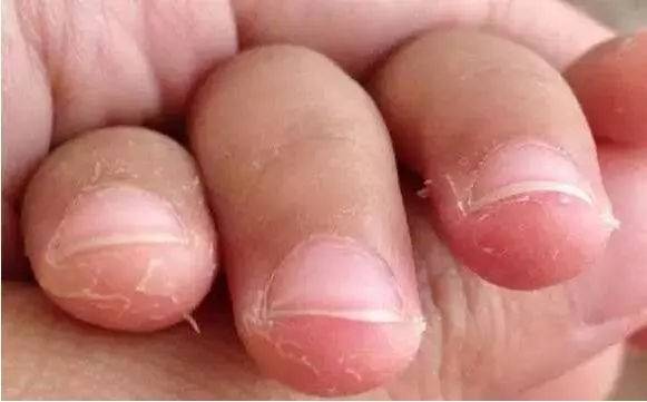 小孩手指脱皮不单是缺维生素，还有哪些原因？家长别忽略了