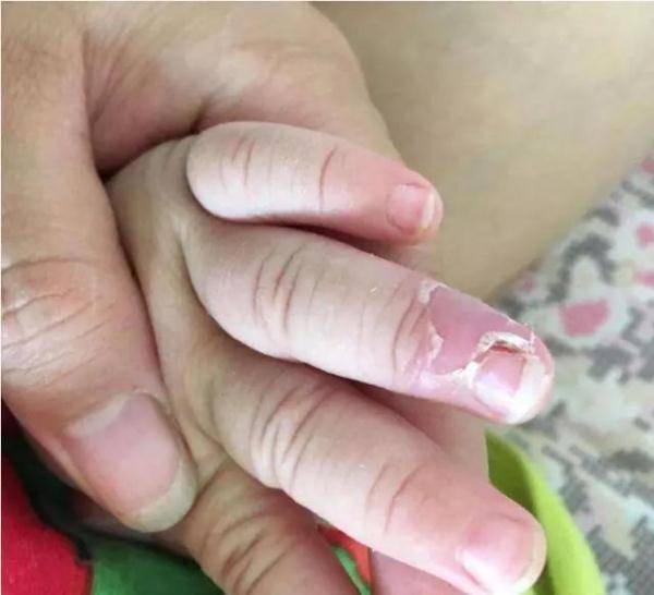 小孩手指脱皮不单是缺维生素，还有哪些原因？家长别忽略了