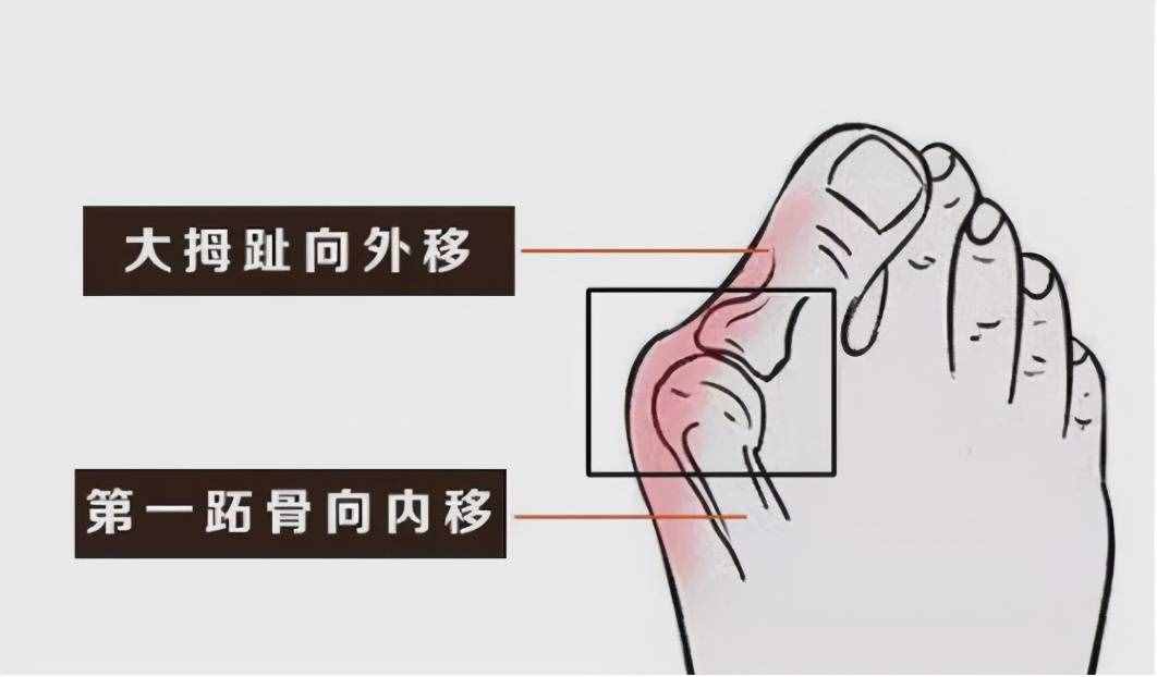 名医话健康|李三忠：拇趾外翻畸形“丑”，磨人的“大脚骨”真痛苦