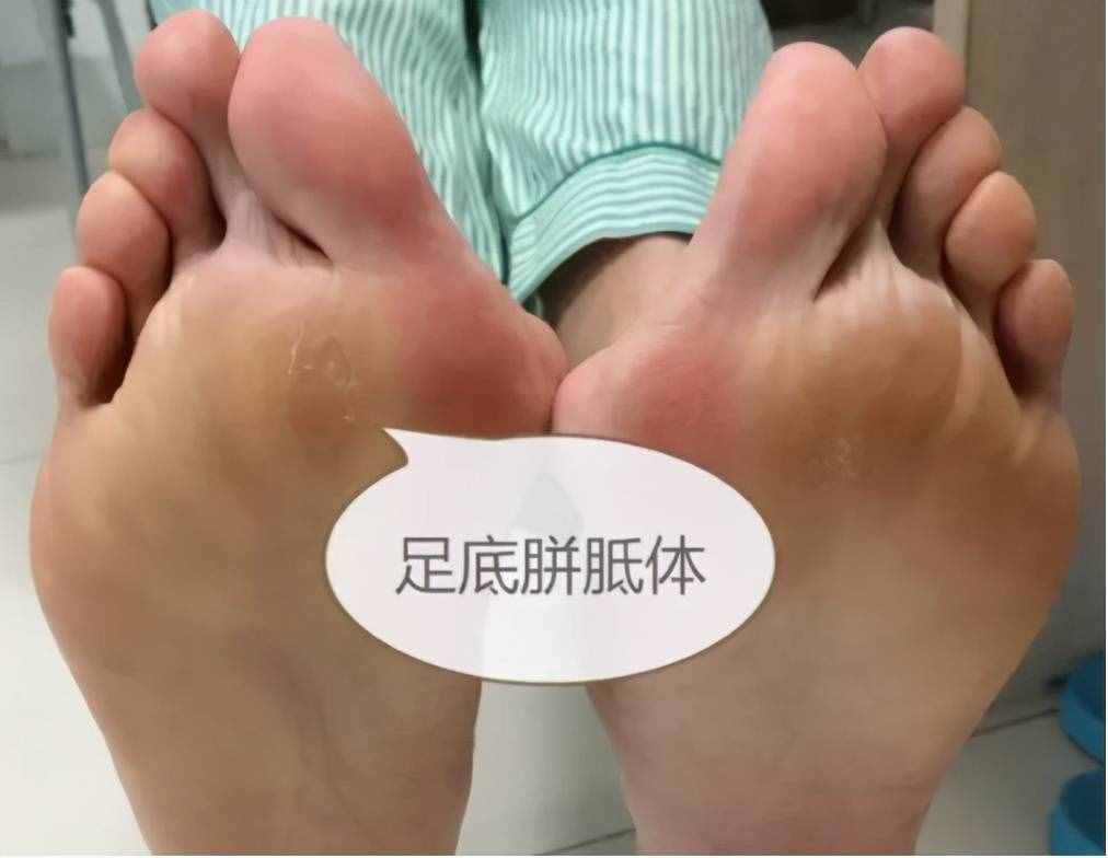 名医话健康|李三忠：拇趾外翻畸形“丑”，磨人的“大脚骨”真痛苦