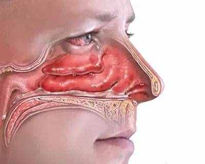 原来鼻塞都是由这些疾病引起的，有鼻塞症状的都应该了解一下。