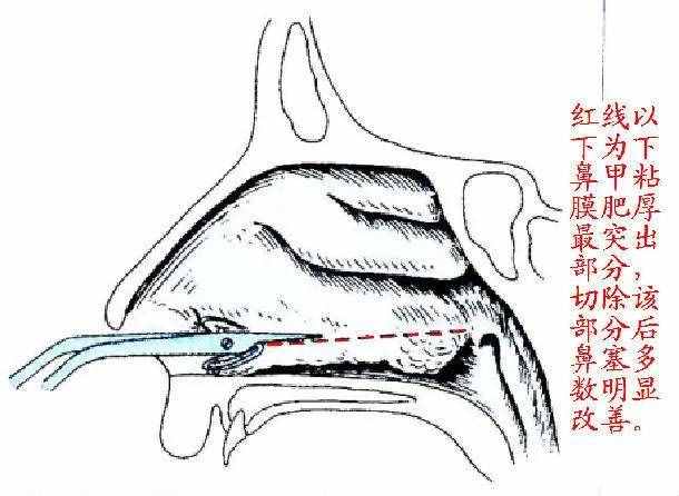 原来鼻塞都是由这些疾病引起的，有鼻塞症状的都应该了解一下。