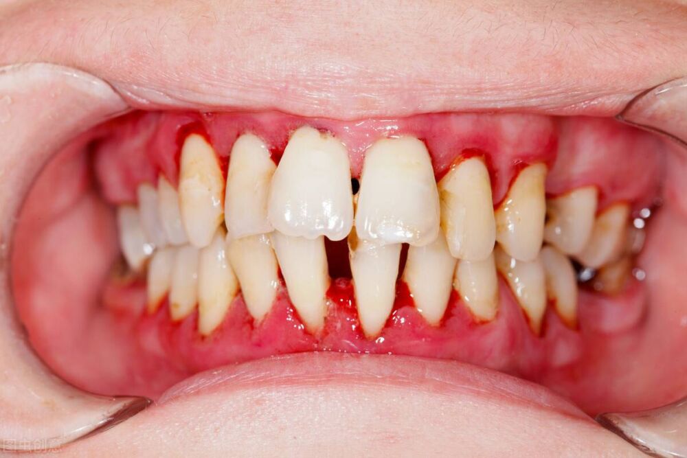 牙龈萎缩牙齿松动有办法补救吗？这个方法可以试一试