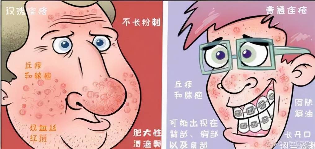 面部泛红起脓疱疹反复2年余，原来患的不是痤疮，而是玫瑰痤疮