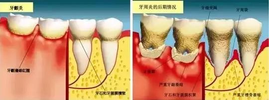 牙周炎！正在杀死95%中国人的牙齿！#雅悦齿科#