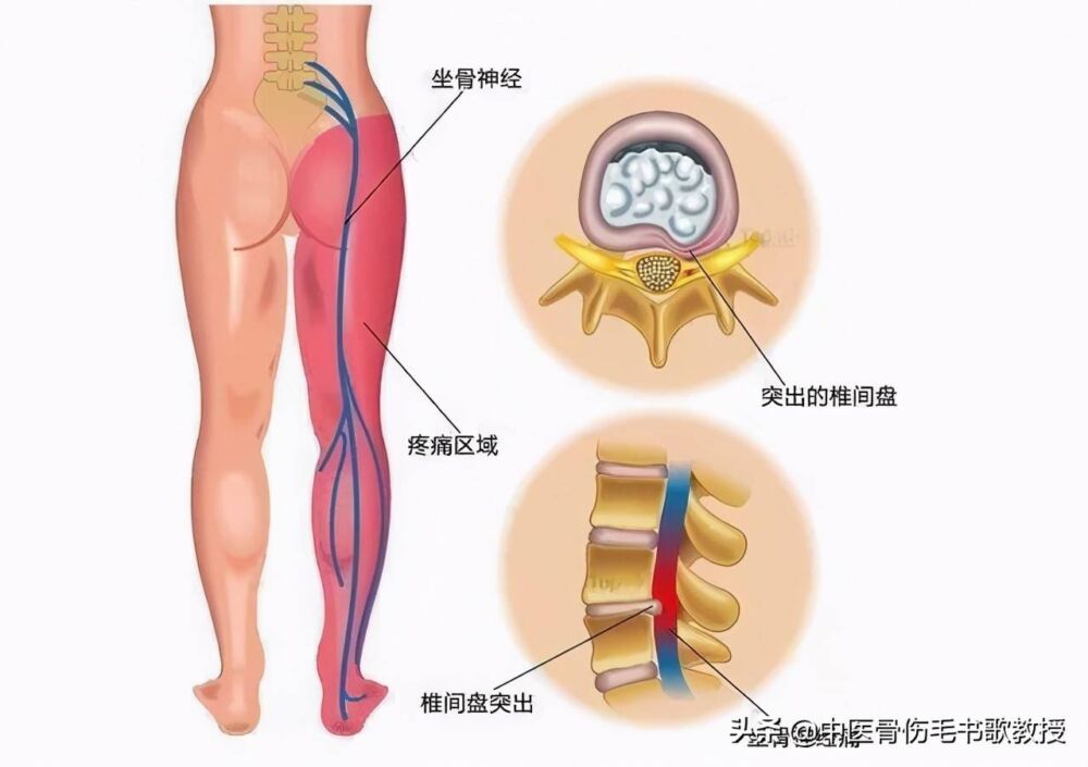 臀部、大腿后侧疼痛，坐骨神经痛，必备两种拉伸法，有效缓解疼痛