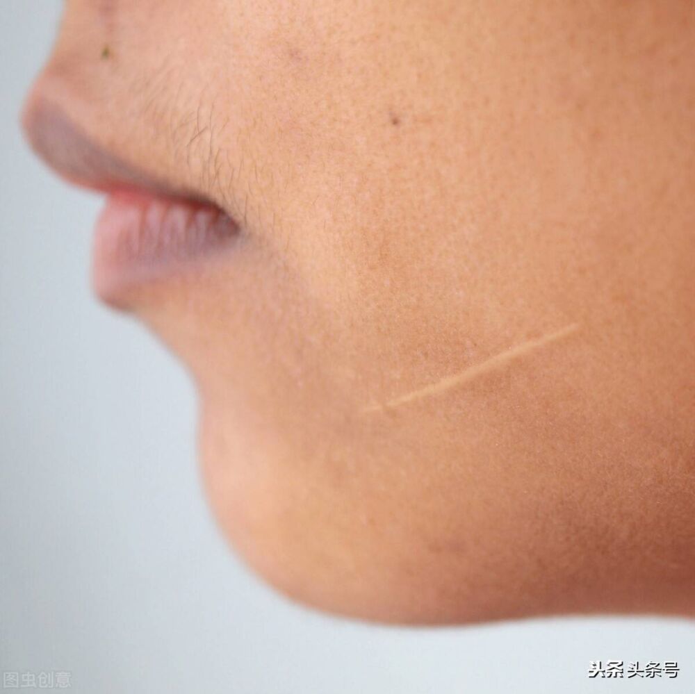 脸上意外留下疤痕怎么办呢？这几种方法可以有效去除