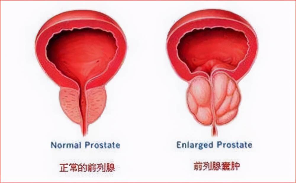 前列腺囊肿会发生癌变吗？该怎么治疗？