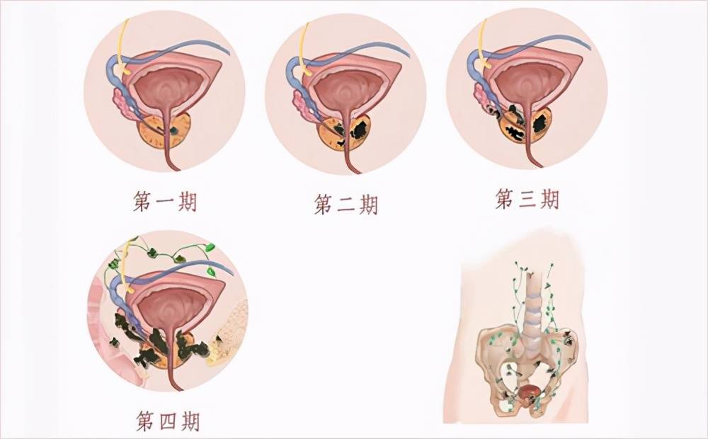 前列腺囊肿会发生癌变吗？该怎么治疗？