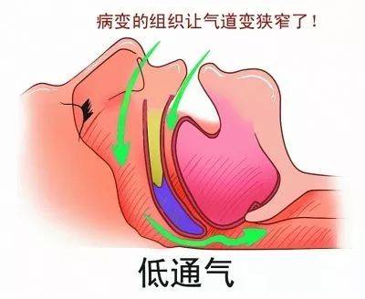 打鼾的人注意！呼噜声越大，越要抓紧看