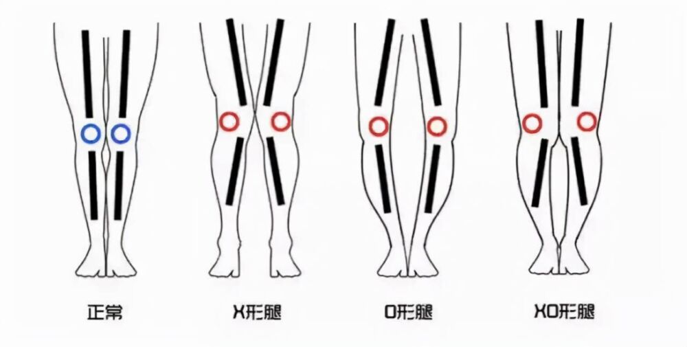 体式 | 如何通过瑜伽矫正XO型腿，妥妥收藏