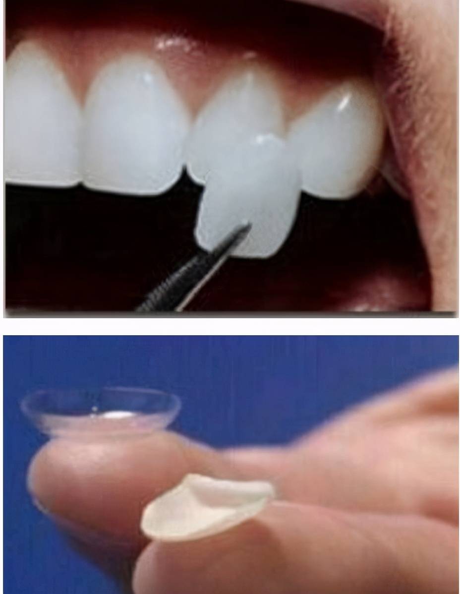 牙科医生讲义第十八讲：解读一种牙齿美容制作方法——贴面