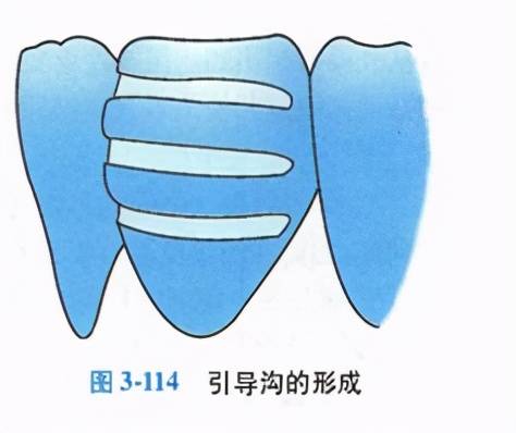 牙科医生讲义第十八讲：解读一种牙齿美容制作方法——贴面