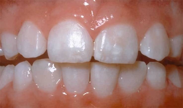 氟斑牙，四环素牙能刷白吗？