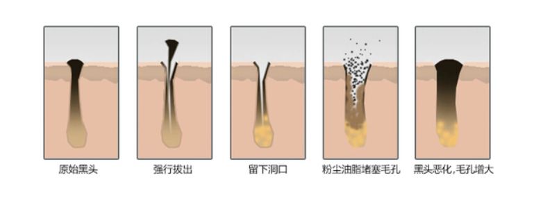 长了“黑头”到底能不能挤？很多人都搞不懂，难怪黑头越去越多