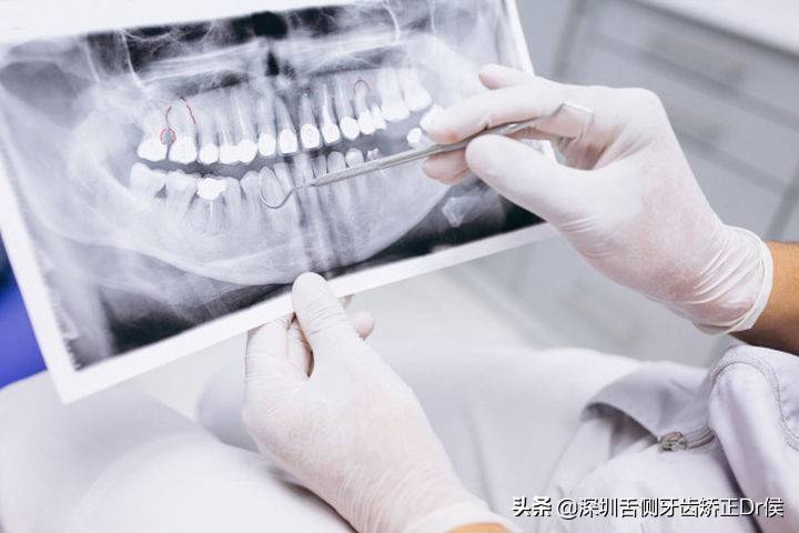 拔牙矫正对身体有害？
