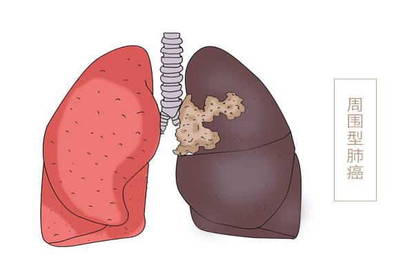 肺部有癌，胸背先知？胸背若出现两种感觉，建议早点查下肺