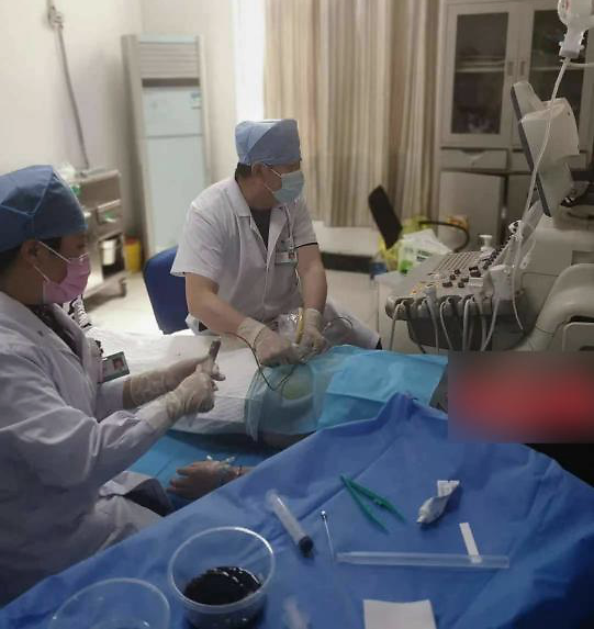 临沂市第三人民医院超声介入治疗一大型巧克力囊肿