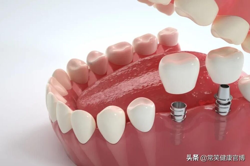 看牙贵、看牙难，一万多块钱的种植牙有望进医保了？