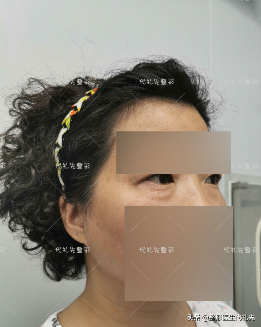 说说我在北京做“外切去眼袋手术”的亲身经历和术后的感受