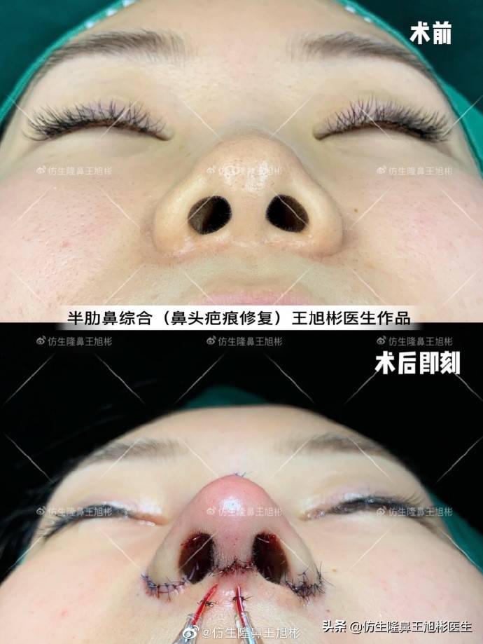初鼻整形：鼻综合（鼻基底填充 鼻翼缩小上提 鼻骨内推）气质换人