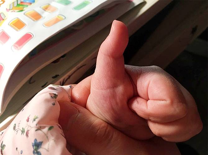 孩子手指伸不直，竟然是狭窄性腱鞘炎，可以保守治疗吗？