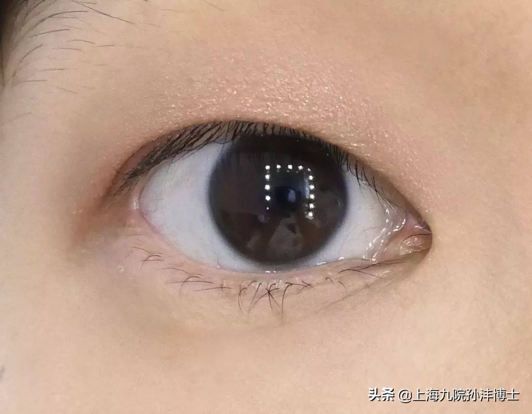 眼修复孙沣博士：什么季节做双眼皮恢复快？