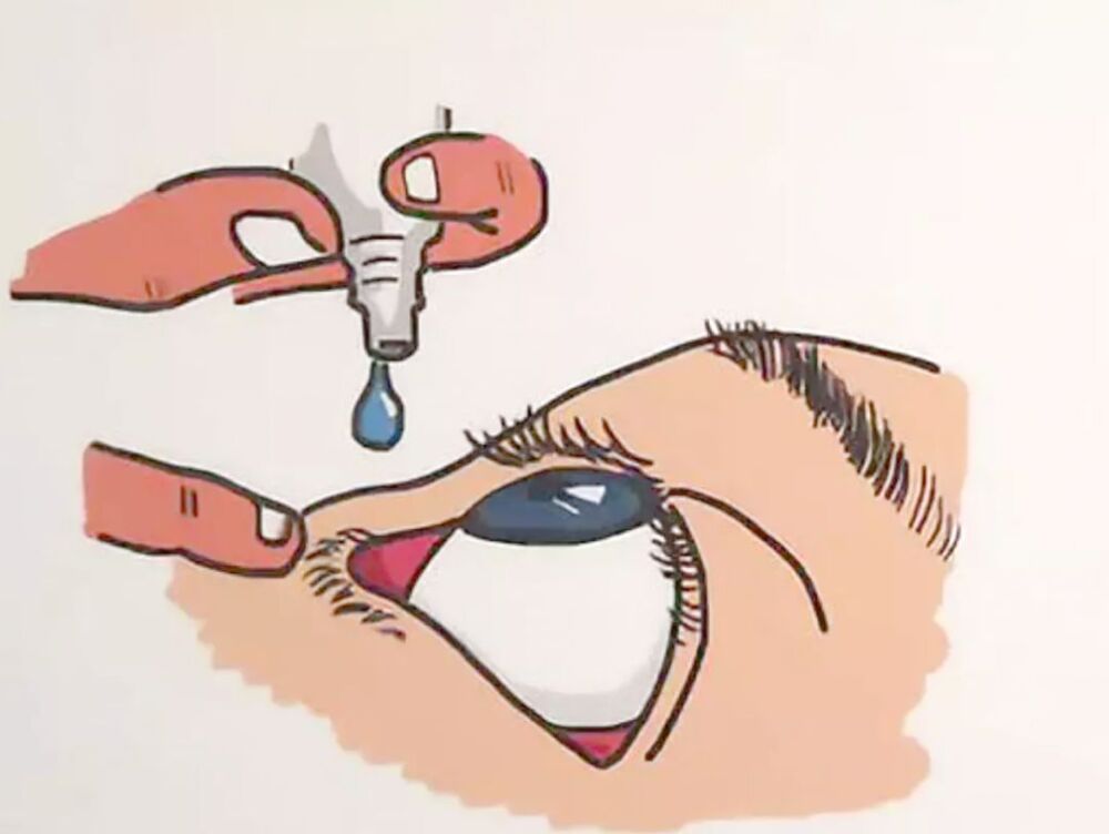 眼药水应滴到眼睛里的哪个部位，你知道吗？