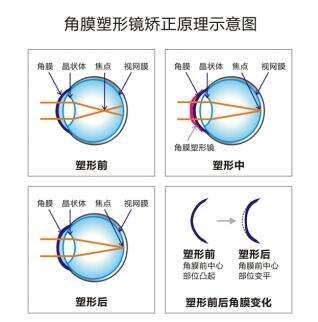 开学迎来配镜潮，孩子眼镜应该怎么挑？