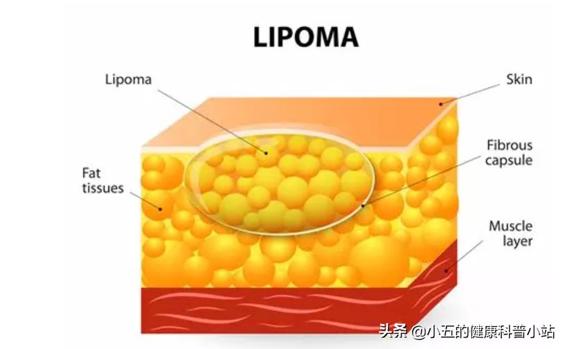 什么是脂肪瘤，它会癌变吗，我们应该怎么正确治疗脂肪瘤