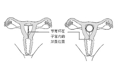 上环手术全过程和手术时间 真实案例