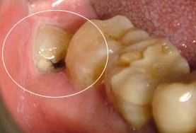 智齿“急性冠周炎”，居家该如何处理？