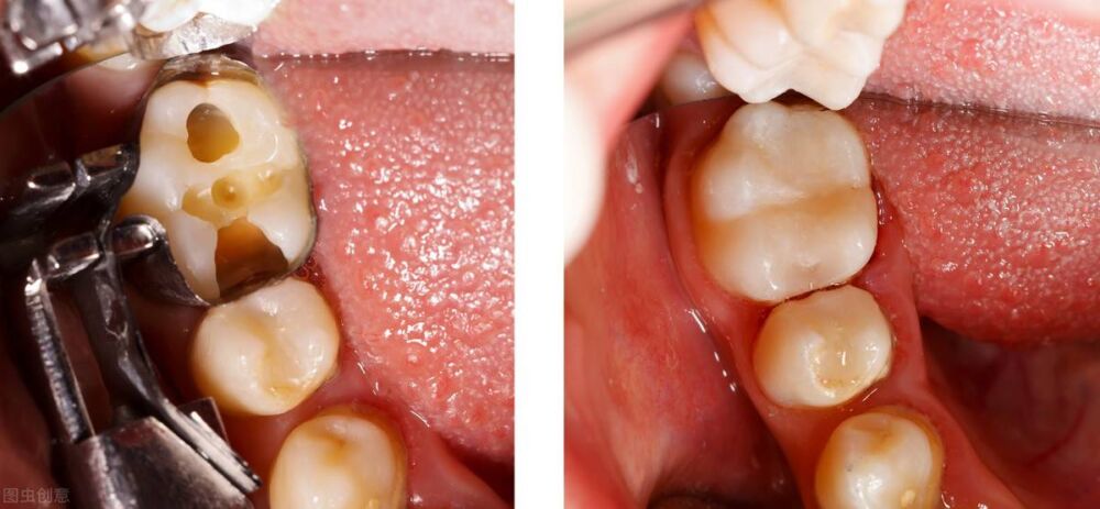 补一次牙齿能坚持多久？补牙适合用什么材料？