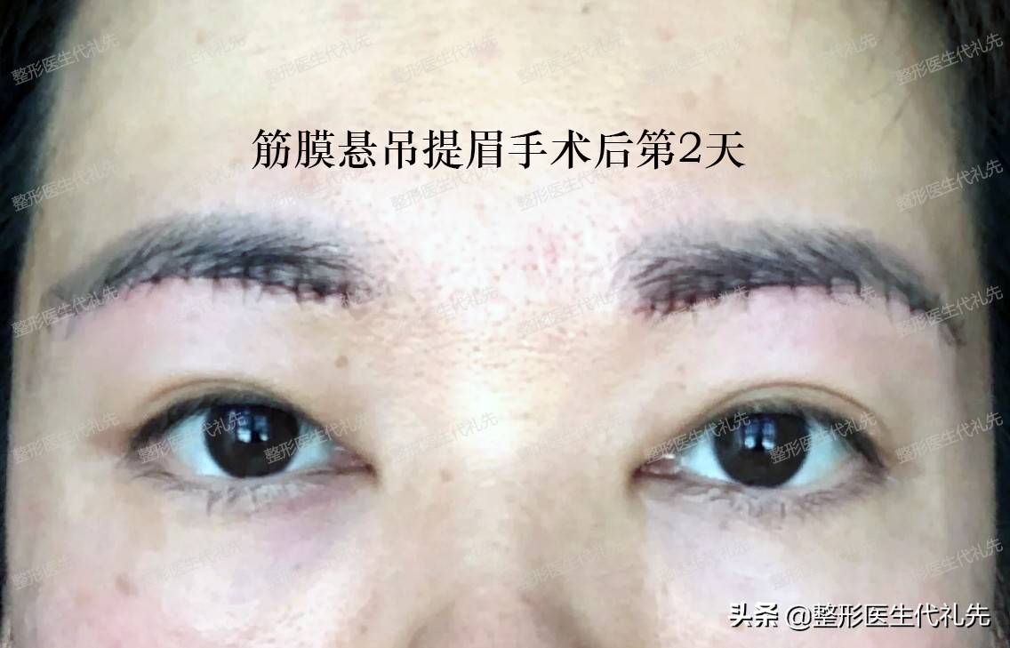 提眉手术可以保持几年？多久可以恢复？提眉手术多久能恢复自然？