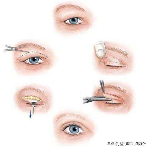 做双眼皮手术大概是什么样的过程？什么是眼神调节？