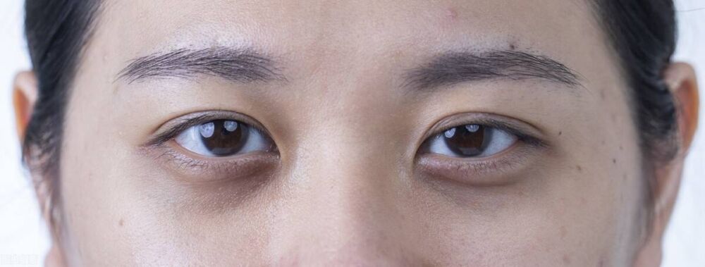 玻尿酸注射去除黑眼圈，是怎么操作的？有何优缺点？医生讲解仔细