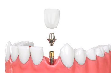 种植牙手术是不是很恐怖？种牙的过程痛苦吗？