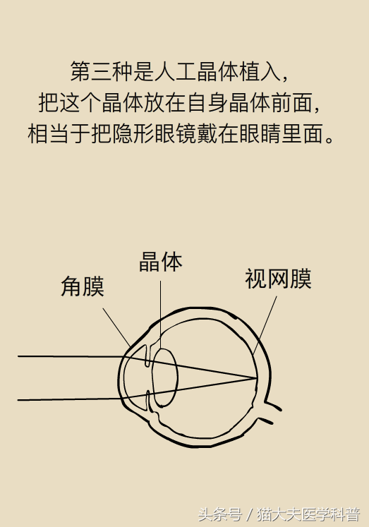 激光近视手术只需十几秒，这么“随意”真的好么？