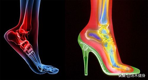 导致女性出现小腿粗肿的肌肉型小腿的三个原因及解决方法