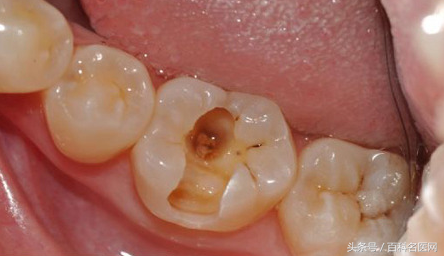 牙洞是怎么产生的？有哪些危害？有哪些治疗方法？