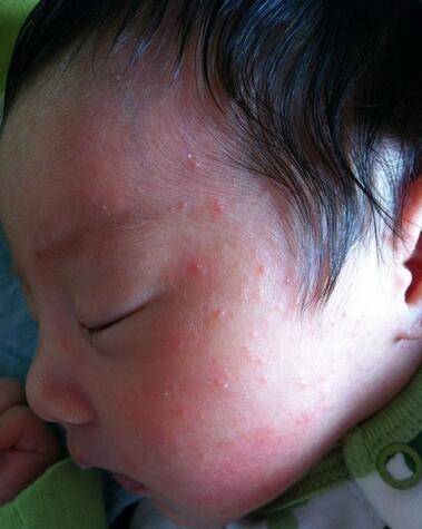 婴儿湿疹是由什么原因引起的？又应该如何防治呢？