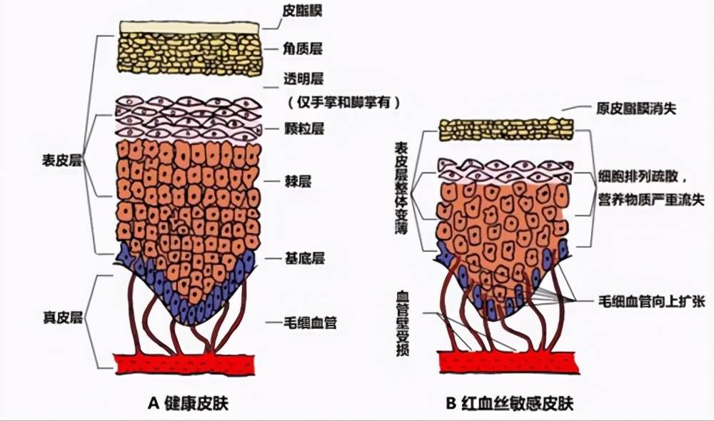 伊的家护肤分享：脸部红血丝产生原因及改善方法